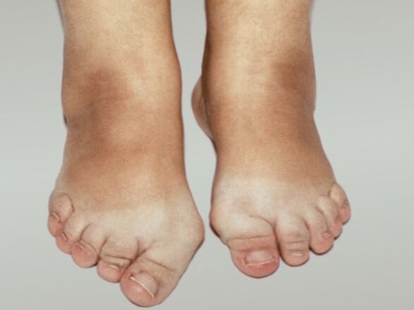 Ayak parmaklarında ciddi deformasyonla birlikte ayak osteoartriti