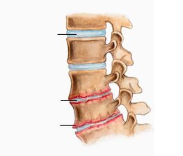 Osteokondroz