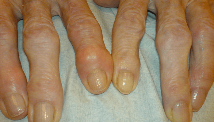 osteoartritli parmak eklemlerinde ağrı