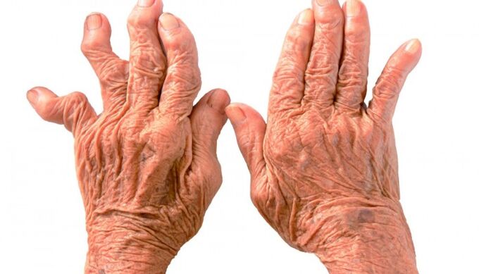 parmak eklemlerinde ağrı nedeni olarak romatoid artrit