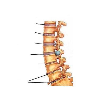 Osteokondroz gelişiminin aşamaları
