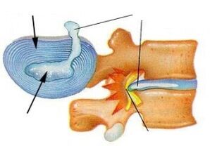 Servikal osteokondrozda fibröz halkanın tahrip edilmesi