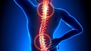 Osteokondroz gelişim mekanizması