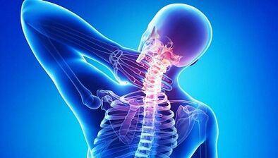 Osteokondroz nasıl ortaya çıkar