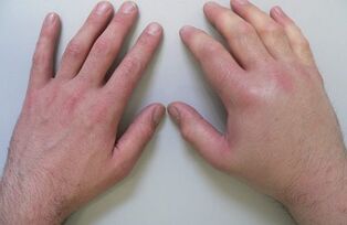 parmak eklemlerinde ağrı nedeni olarak artralji