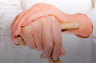 romatoid artritli parmak eklemlerinde ağrı