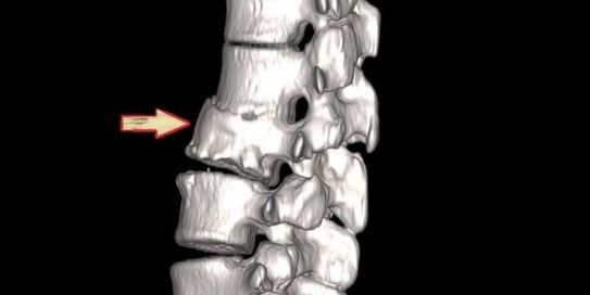 sırt ağrısı nedeni olarak spinal patoloji