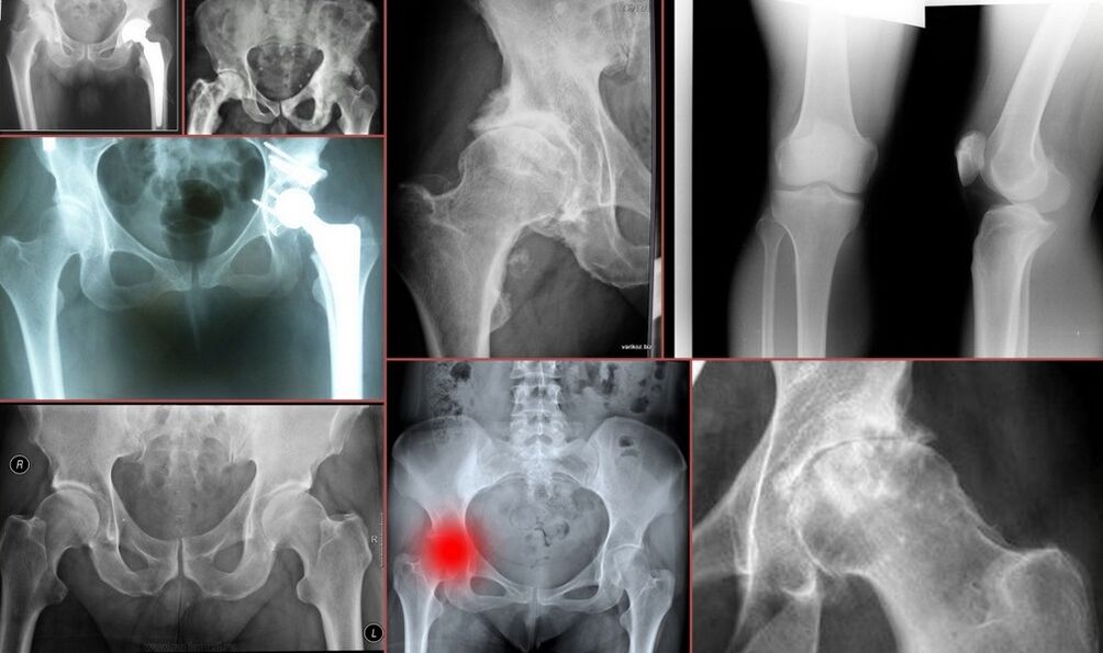 Kalça ağrısı için röntgen