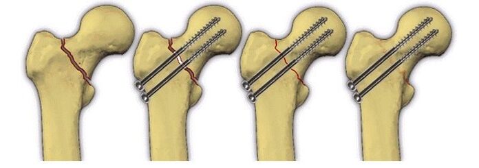 kalça ekleminde ağrı için kemik gövdesinin pimlerle sabitlenmesi