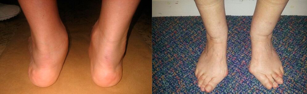 Ayak başparmağının artrozu ve ayak bileğinin deforme olan artrozu
