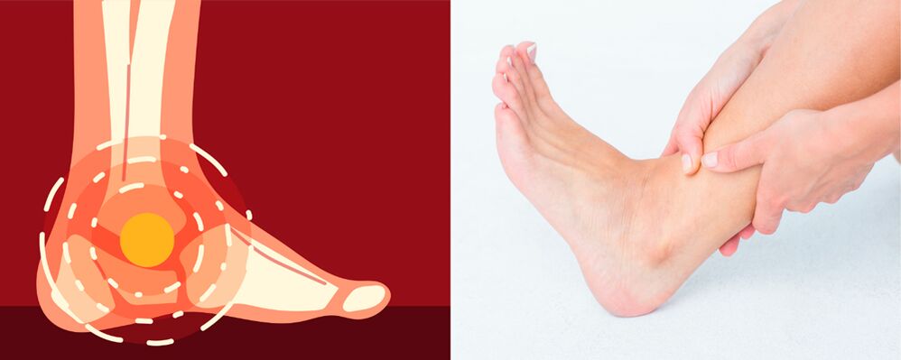 Ayak bileğinin deforme artrozunda ağrıya şişlik, eklem hareketliliğinin azalması eşlik eder. 