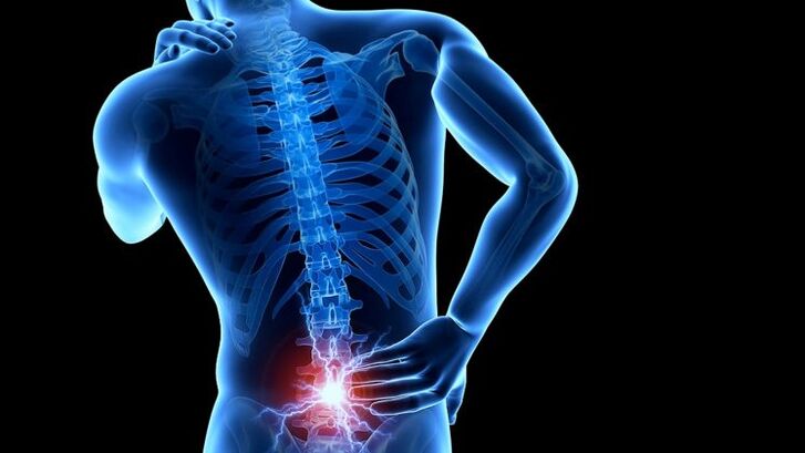 lomber osteokondroz ile sırt ağrısı